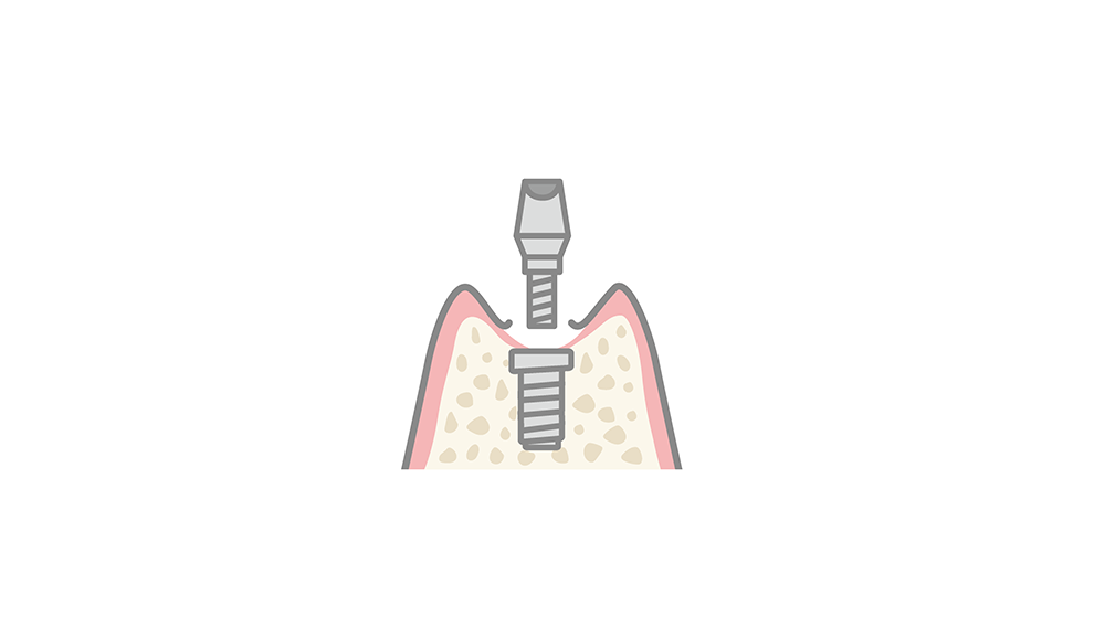 人工歯根と土台の接合