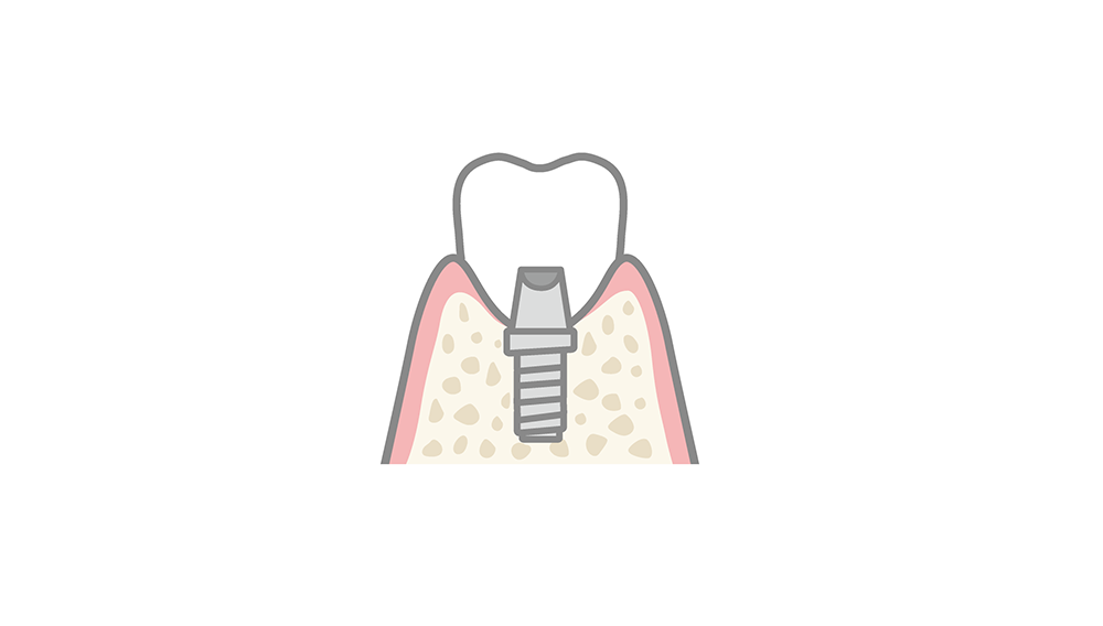 仮歯による歯茎形成