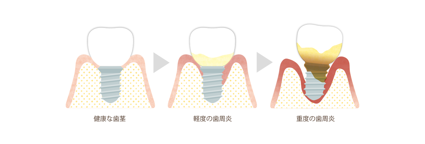 インプラント歯周病の進行度合いによるインプラントへの影響