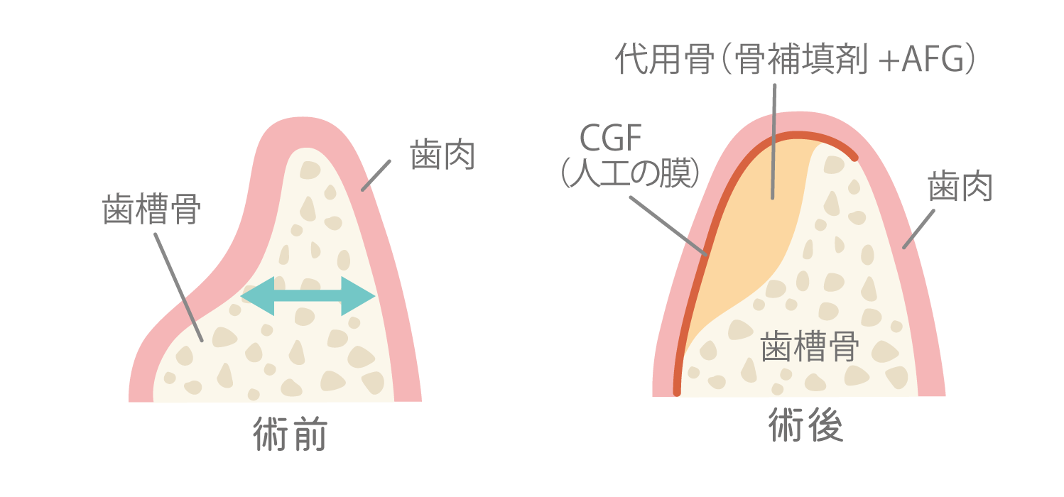 ハート・イン歯科クリニックのAGF（Autologous Fibrinogen Glue）