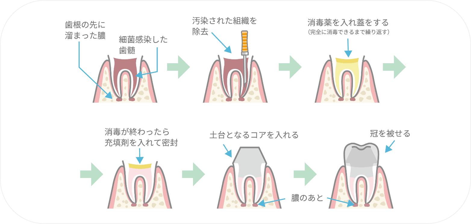 ハート・イン歯科クリニックの歯を残すための治療フロー