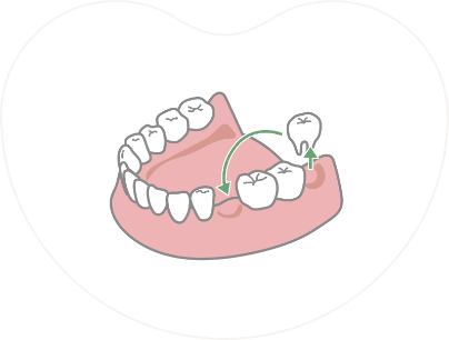 ハート・イン歯科クリニックの歯牙移植