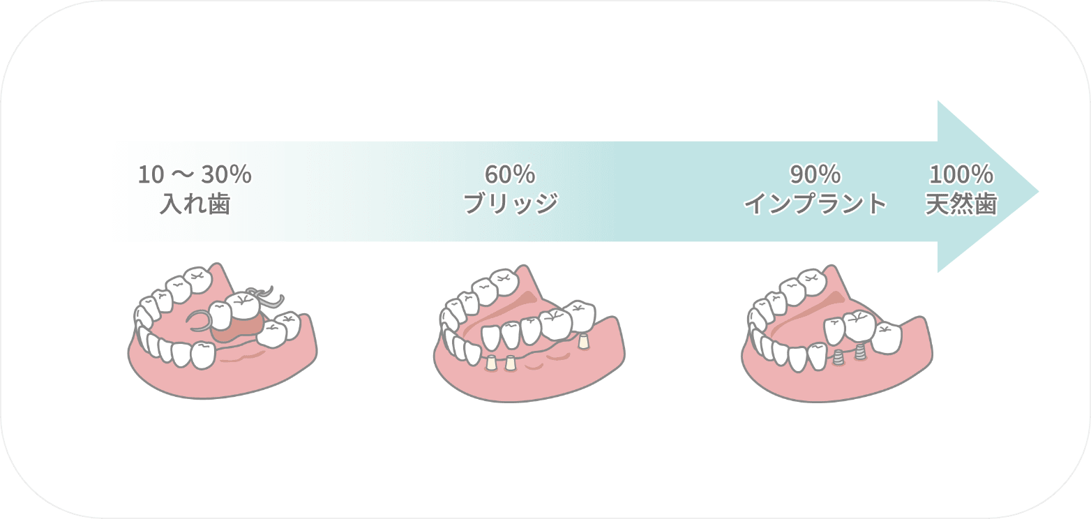噛む力の比較：10%〜30%入れ歯、60%ブリッジ、90%インプラント、100%天然歯