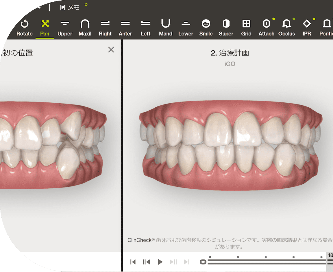 ハート・イン歯科クリニックの3D治療計画ソフトの画面