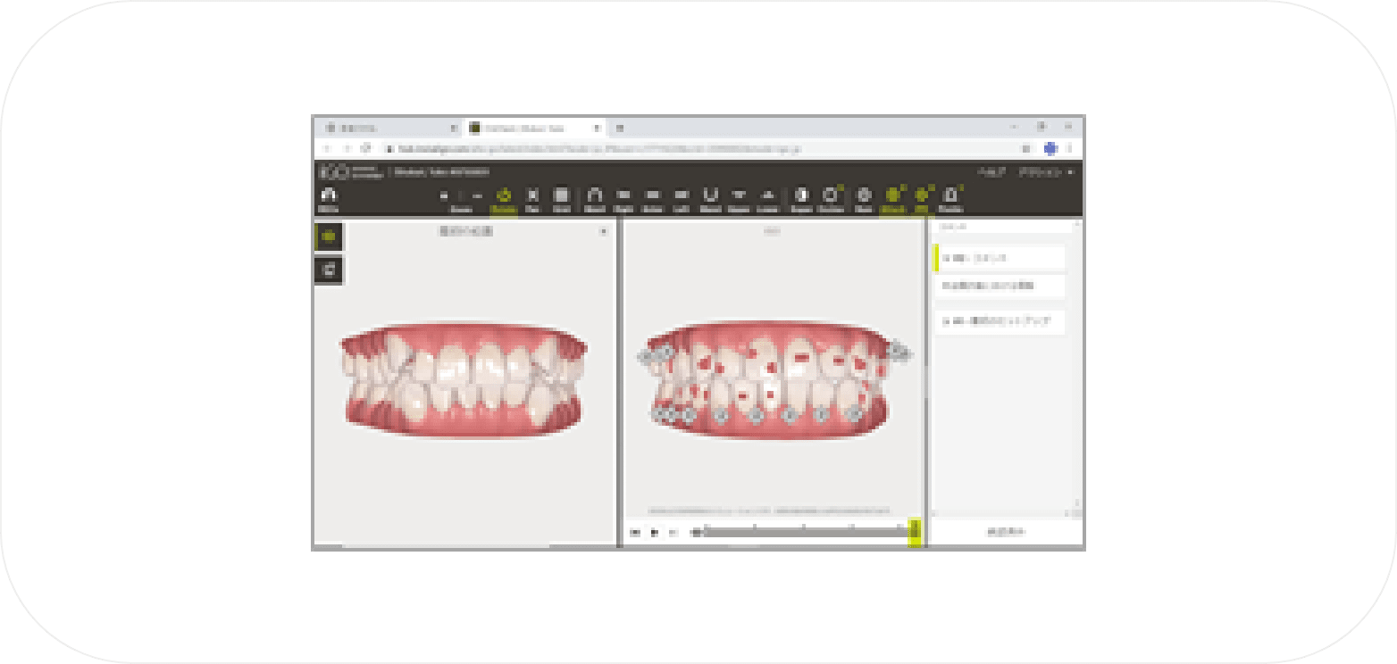 ハート・イン歯科クリニックの3D治療計画ソフト