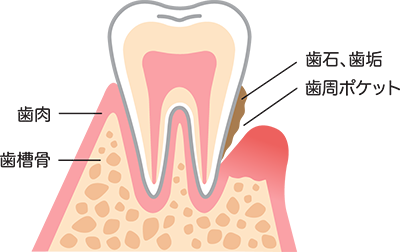 歯周ポケット